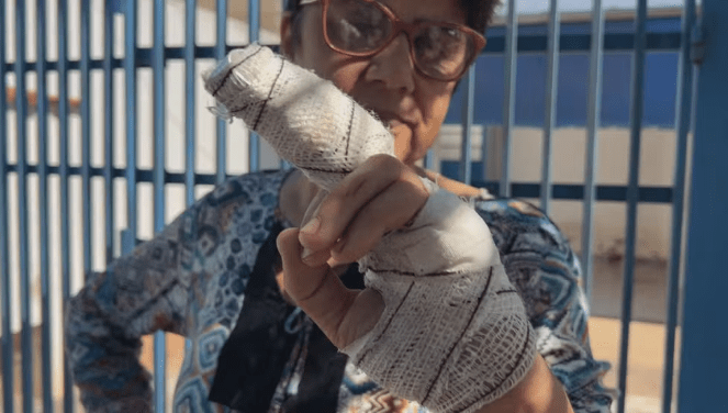 Mulher tem parte do dedo decepado após ataque de pitbull em Marília (SP) (Foto: TV TEM/Reprodução)