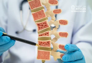 Prefeitura de Botucatu reforça importância da prevenção e do diagnóstico precoce da osteoporose